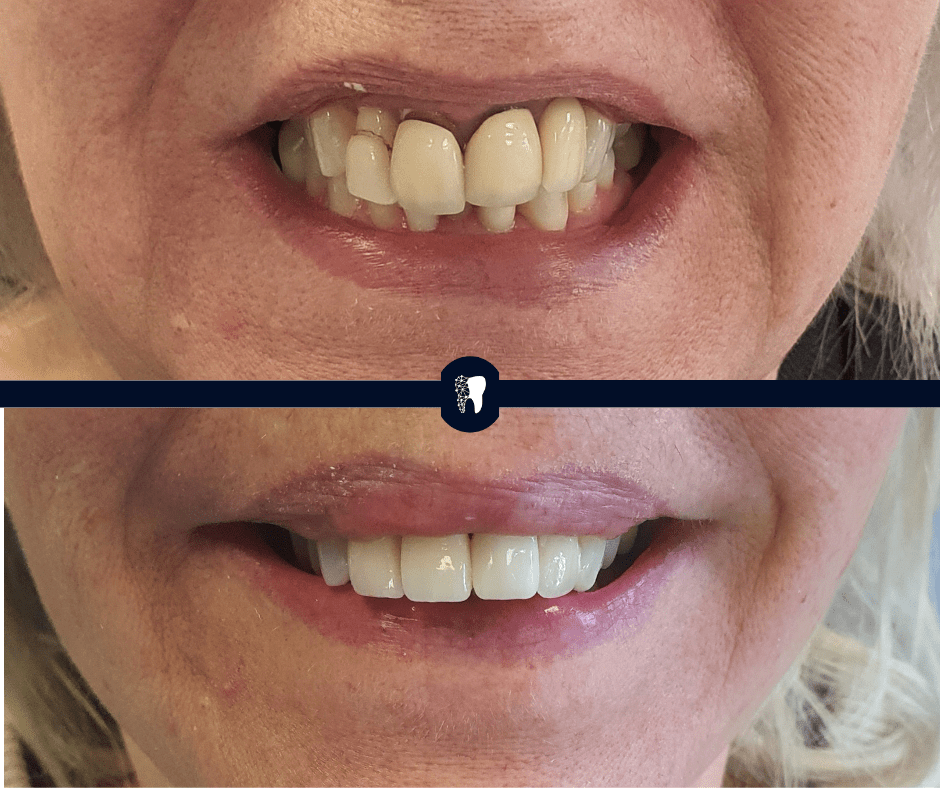 Before and after — smile transformation case 11