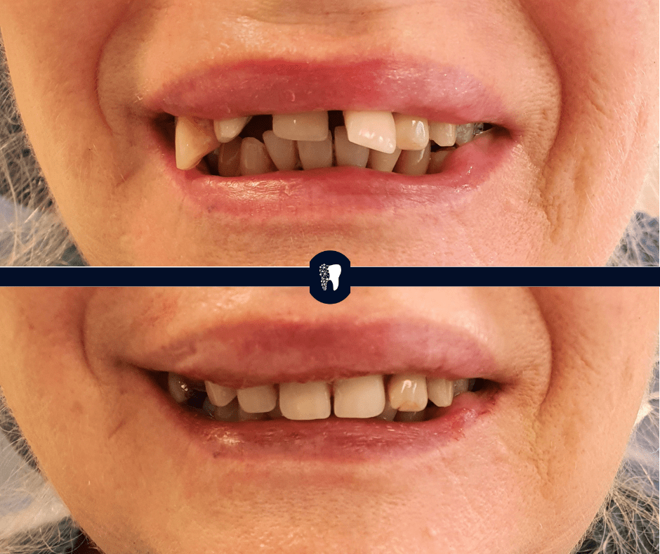 Before and after — smile transformation case 12
