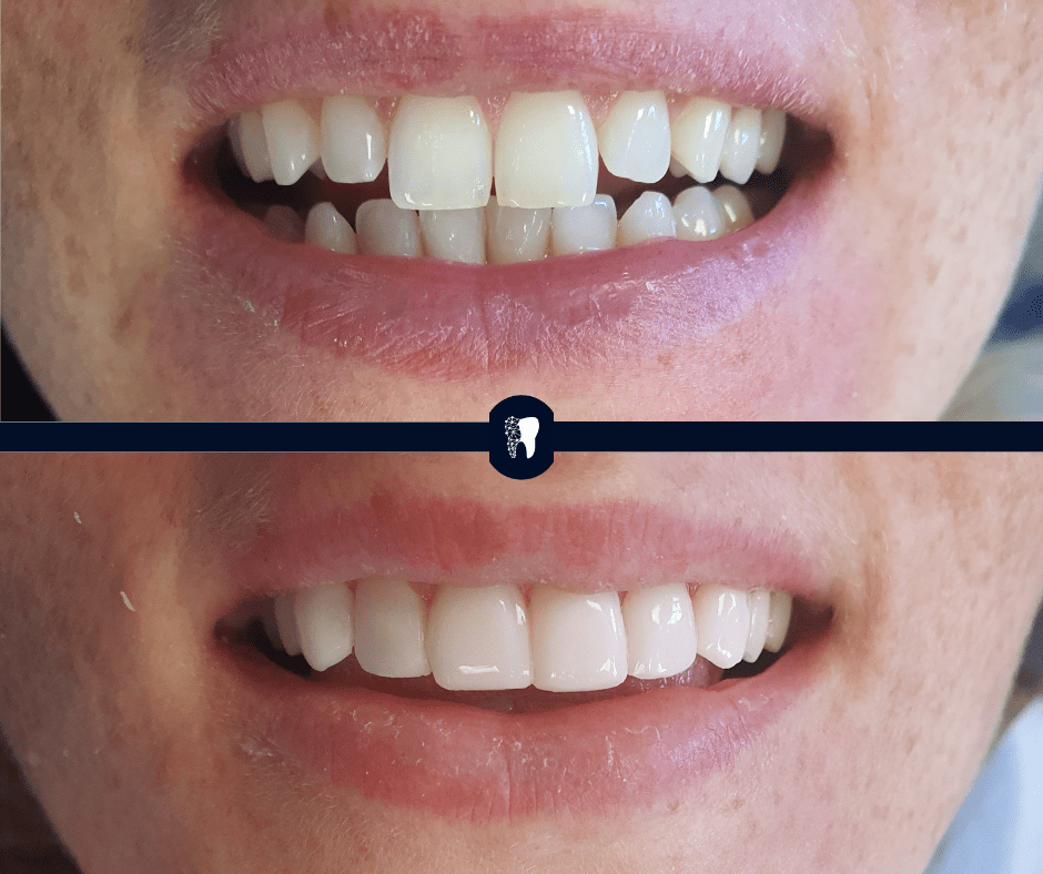 Before and after — smile transformation case 14