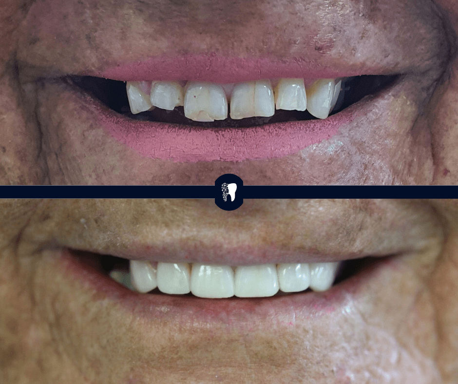 Before and after — smile transformation case 2