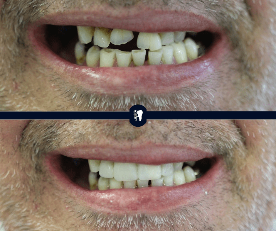 Before and after — smile transformation case 3