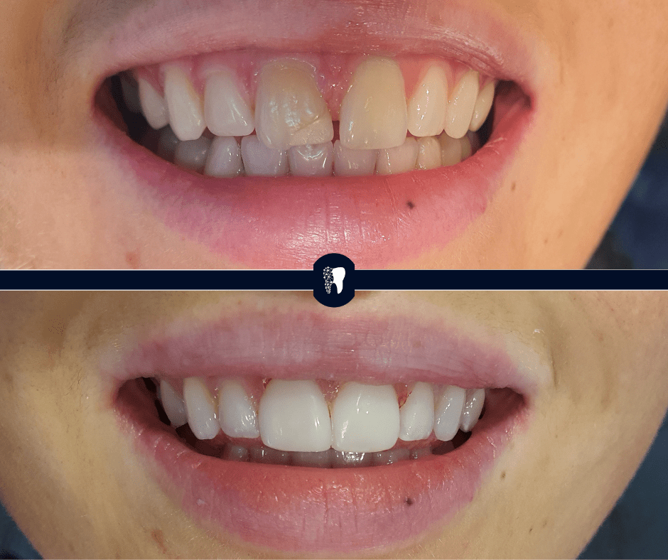 Before and after — smile transformation case 7