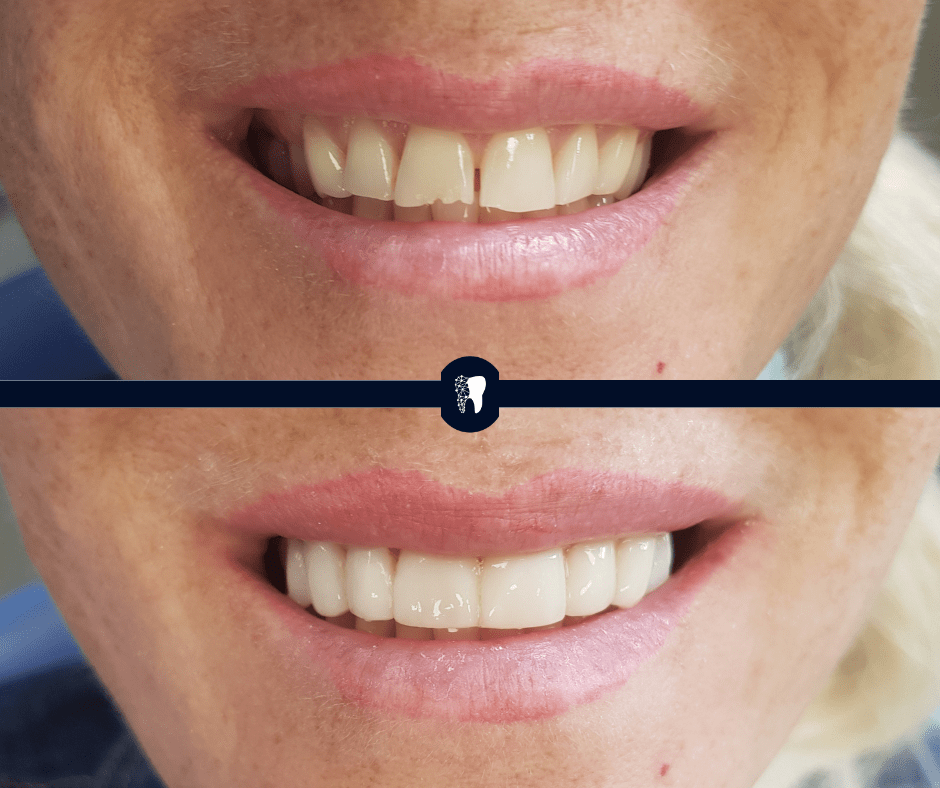 Before and after — smile transformation case 9